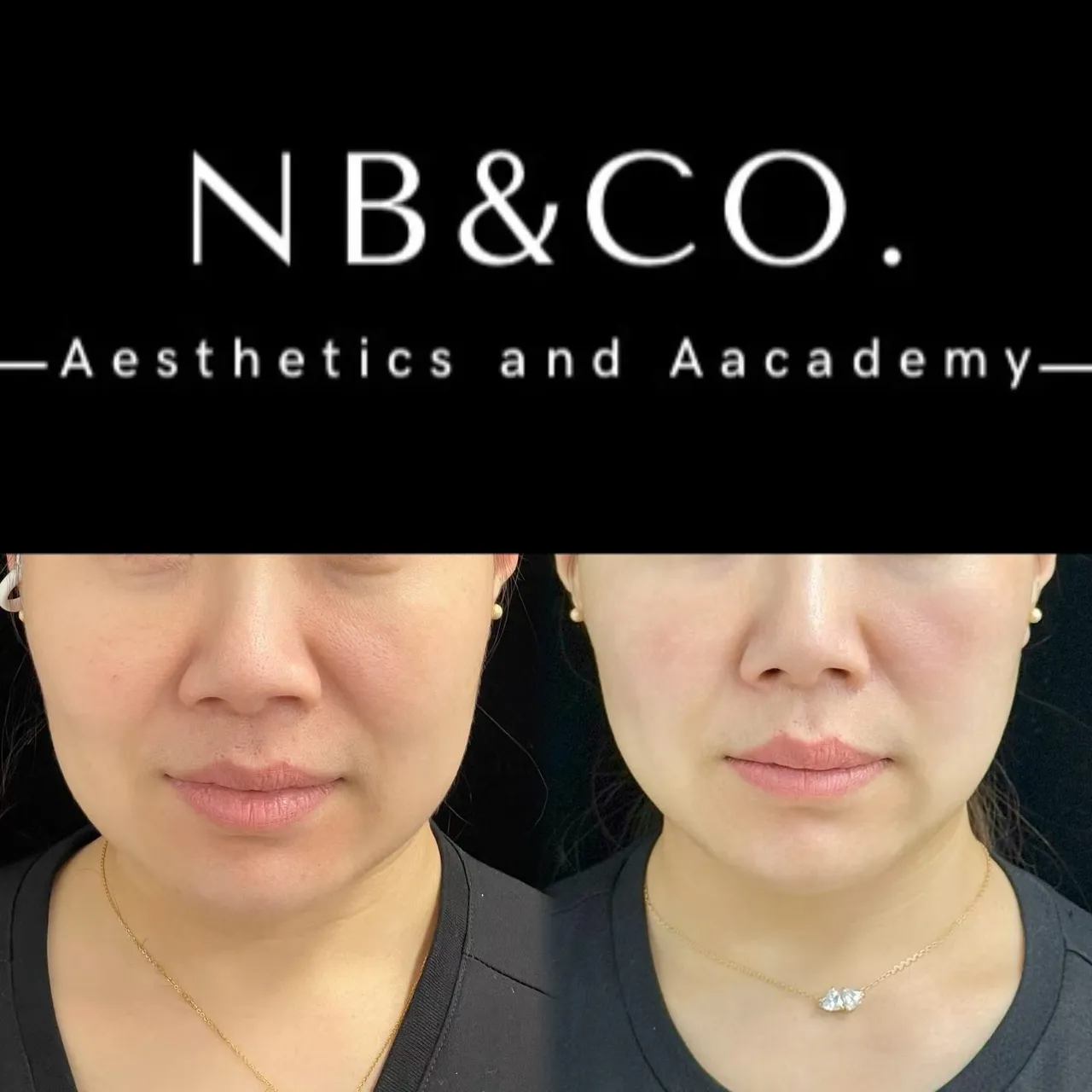 Ultherapy · Real Client Result
