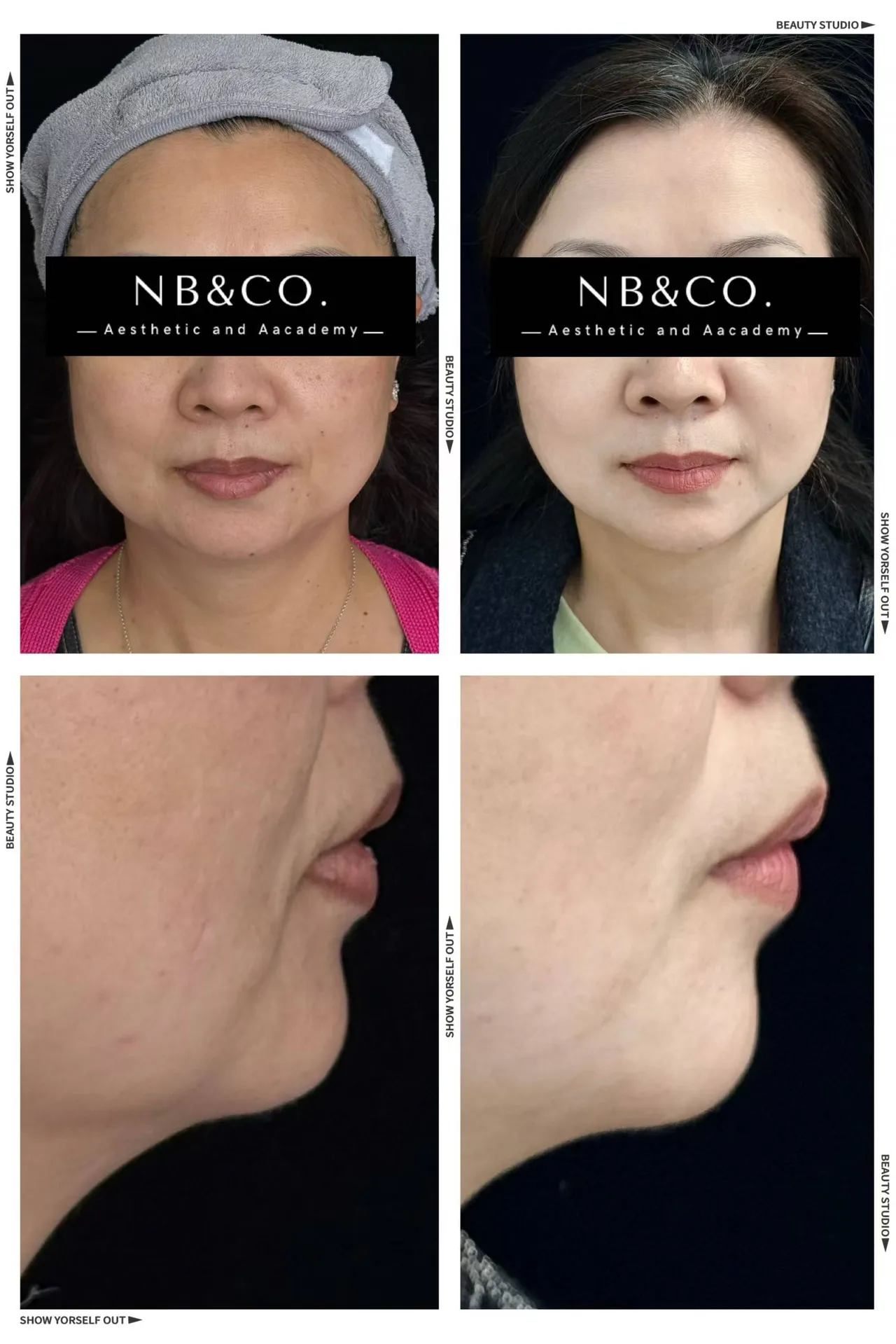 Ultherapy Prime · Face & Jawline Lift
