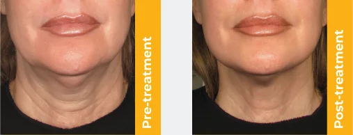 Ultherapy Prime before and after treatment results Melbourne
